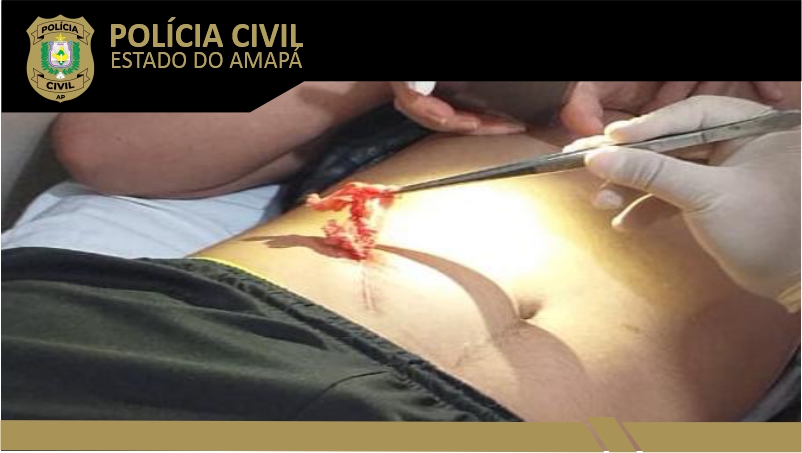 POLÍCIA CIVIL INDICIA MÉDICO QUE ESQUECEU GAZE EM CORPO DE PACIENTE 